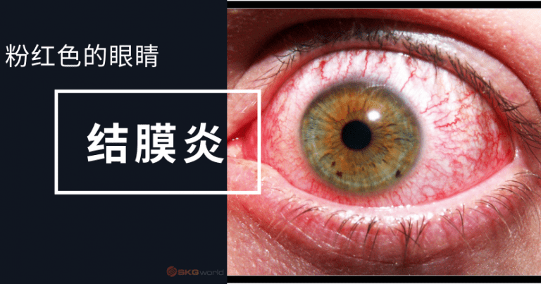 粉红色的眼睛 - 结膜炎 - SKG World